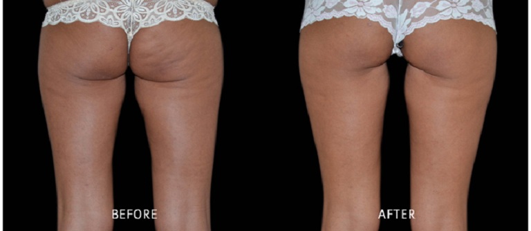 giảm béo đùi bằng công nghệ máy exilis dui exilis 3.jpg (47 KB)